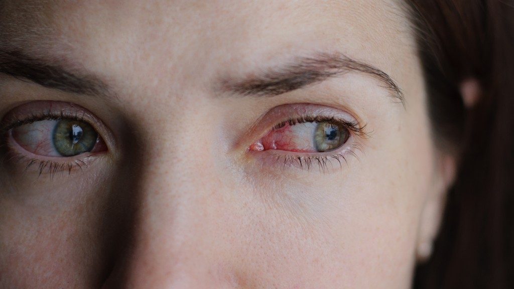 Closeup of irritated or infected red bloodshot eye - conjunctivitis