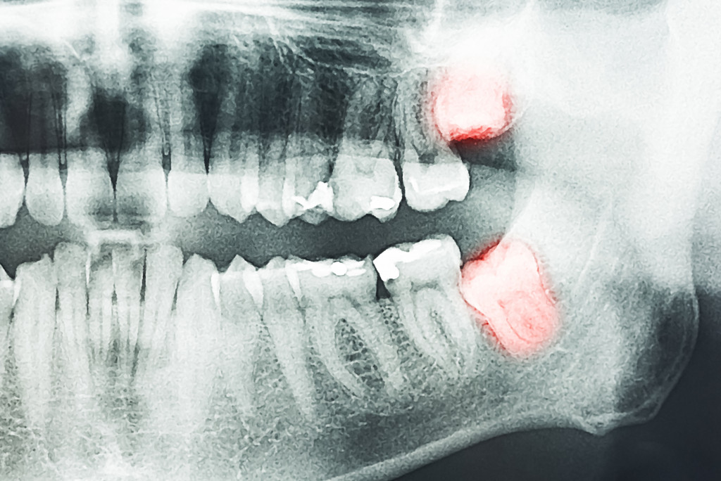 growing wisdom tooth pain xray image